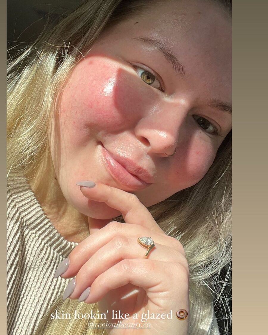 A Revival skin client, from her own story