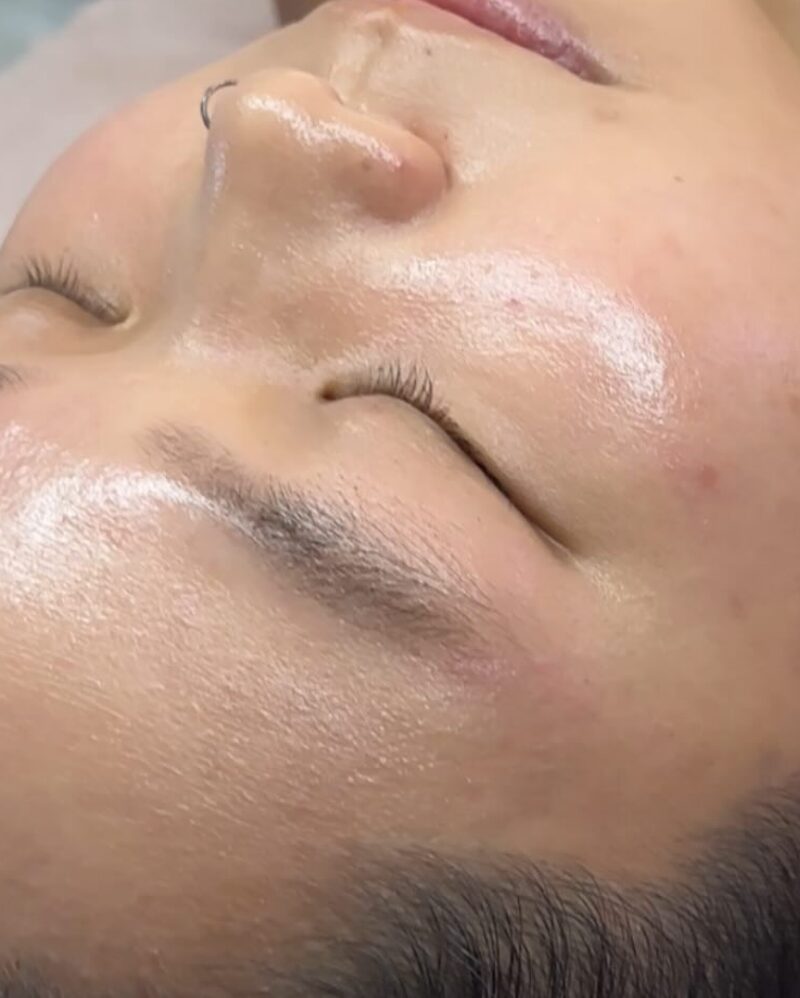 Acne treatment results, September 2023 and October 2024, after