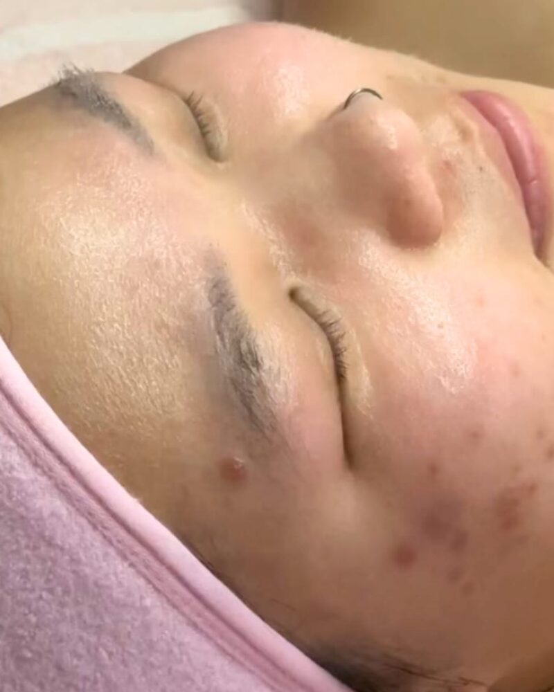 Acne treatment results, September 2023 and October 2024, before