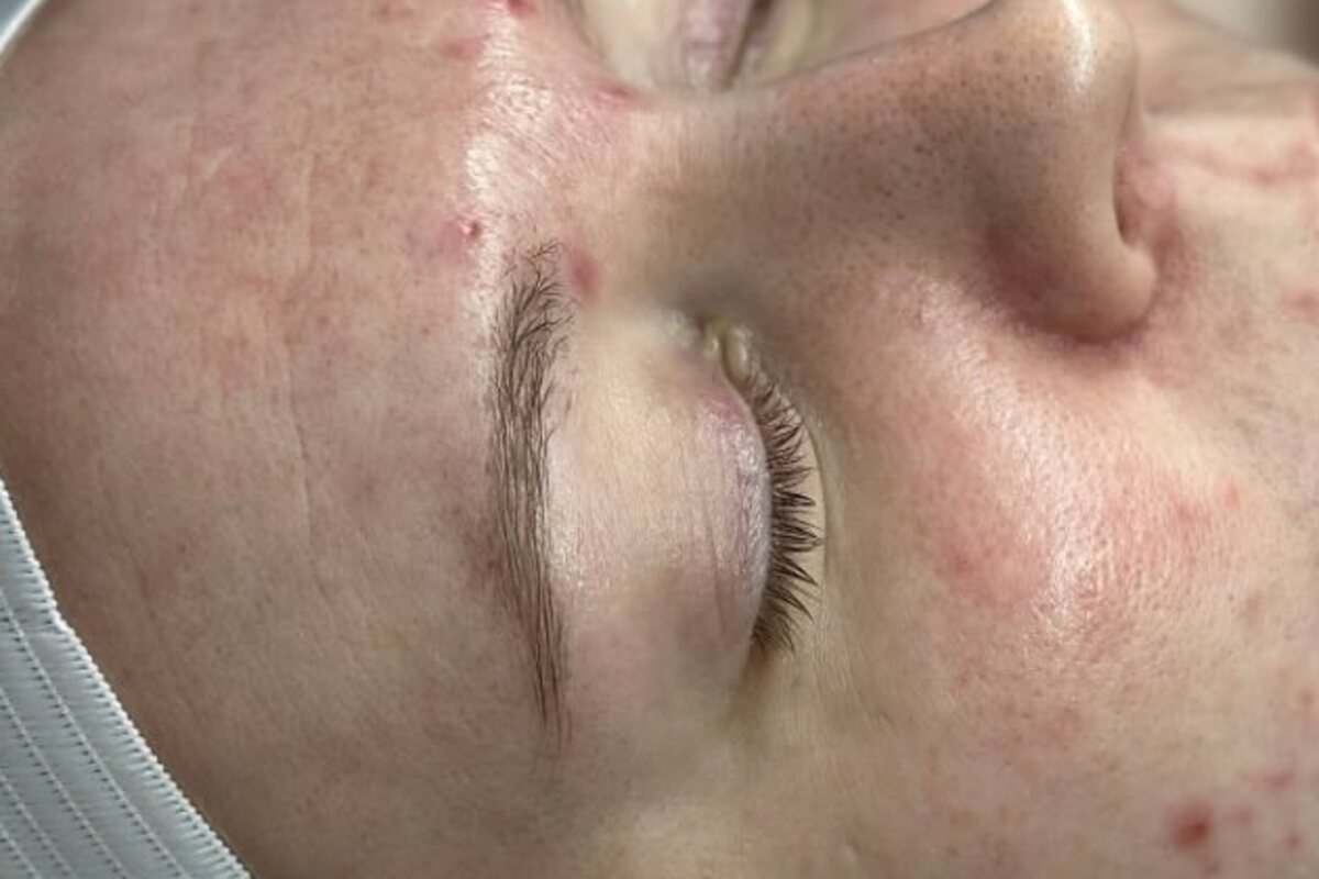 Acne treatment results, November 2022 and September 2023, before