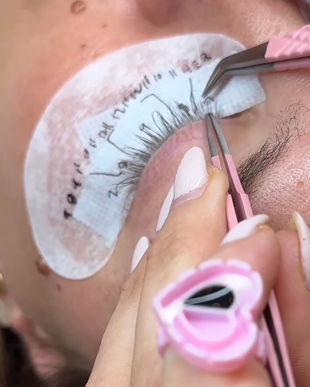 McKinzie mapping and placing a lash set